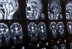 Brain and NeurosurgeryConditions